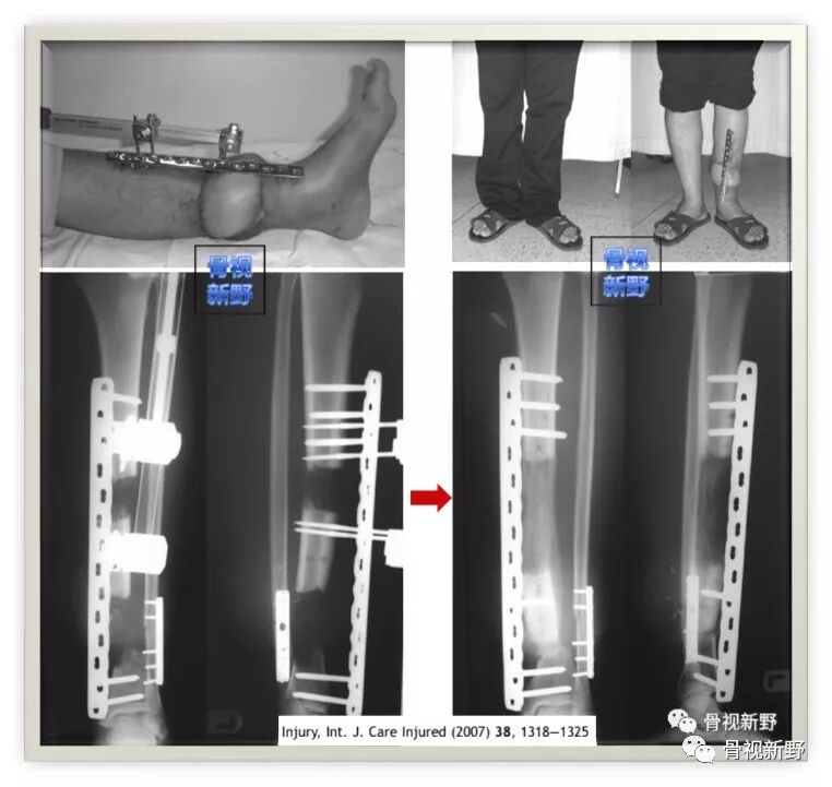 锁定钢板的外固定应用