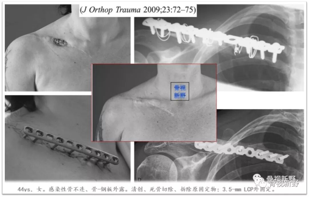 锁定钢板的外固定应用