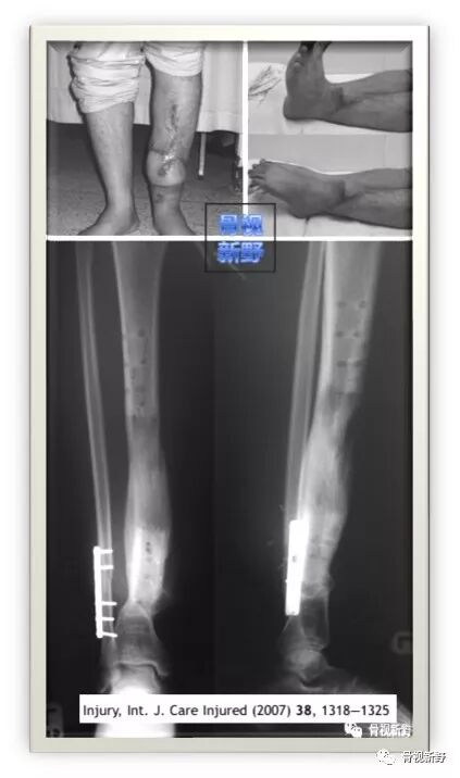 锁定钢板的外固定应用