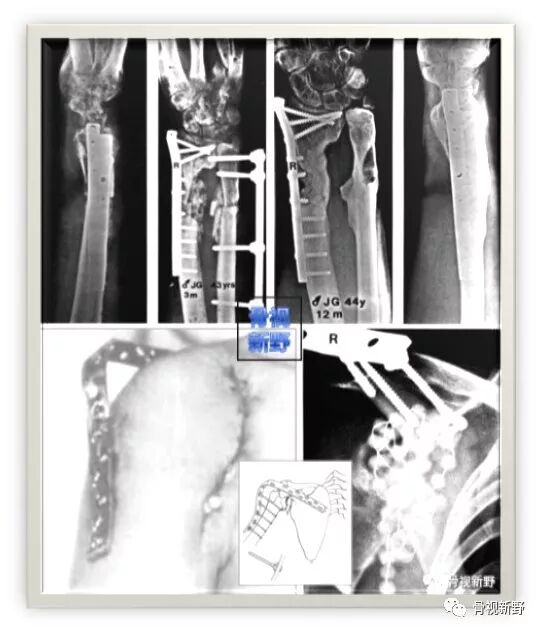 锁定钢板的外固定应用