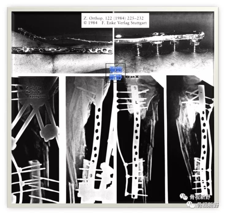 锁定钢板的外固定应用