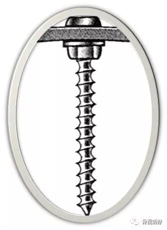 锁定钢板的外固定应用