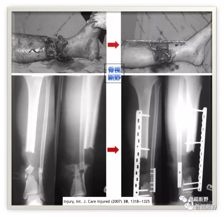 锁定钢板的外固定应用