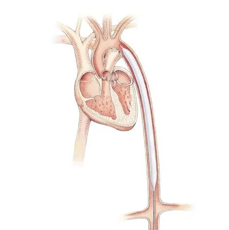 clearcuff加压袋为什么ICU知识小科普系列之IABP_https://www.jmylbn.com_新闻资讯_第12张