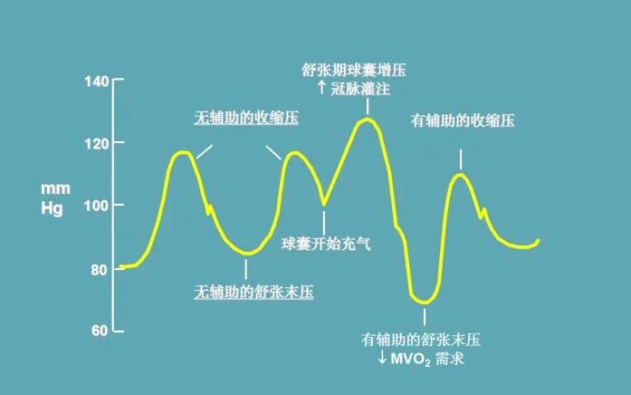 clearcuff加压袋为什么ICU知识小科普系列之IABP_https://www.jmylbn.com_新闻资讯_第9张