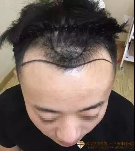 遗传性脱发,秃顶,额角脱发,发际线后退……毛发专家:自己瞎用药后果让