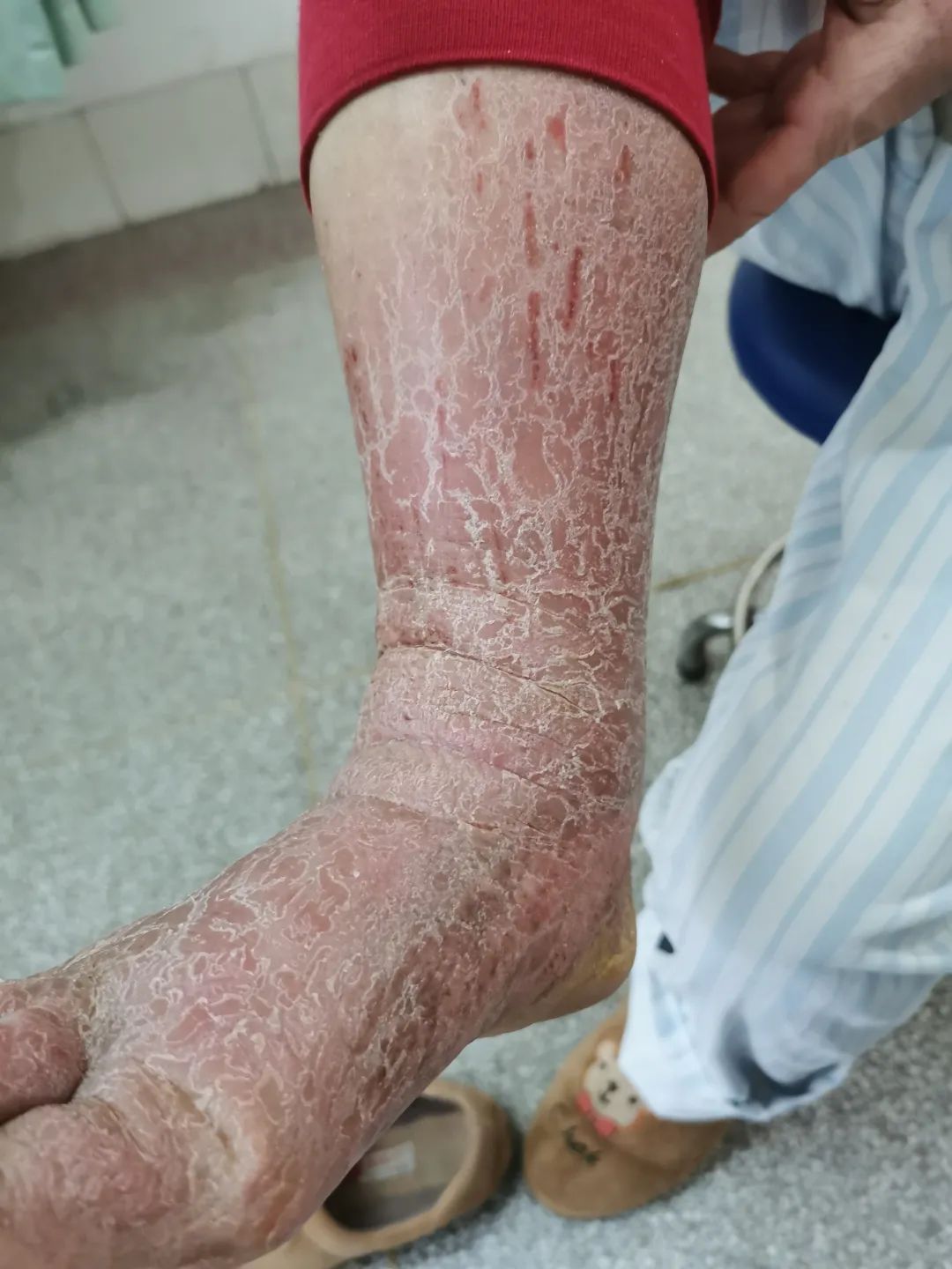 疑难杂症周身皮肤病10年，顽固性湿疹和顽固性手足癣。△ 治疗前△ 治疗后