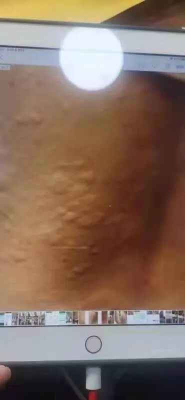 蜕变系列多年慢性湿疹、神经性皮炎、毛囊炎和荨麻疹痊愈三年未复发，十年妊娠纹眼袋黑眼圈同时无情离家出走（有图）