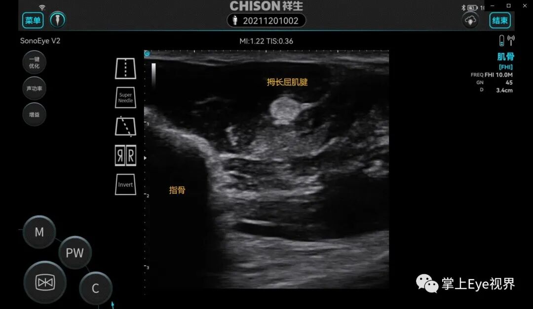 彩超伪像是什么超声基础 ｜ 超声伪像_https://www.jmylbn.com_新闻资讯_第3张