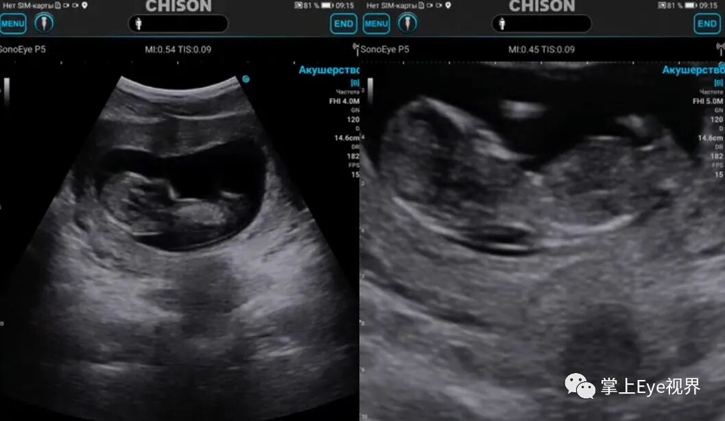 凸阵探头包括哪些超声基础 ｜ 探头的构造及工作原理_https://www.jmylbn.com_新闻资讯_第8张