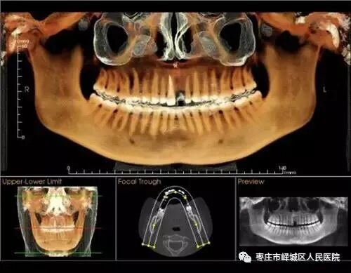 口腔ct怎么看您知道吗？口腔也可以做“CT”哦~_https://www.jmylbn.com_新闻资讯_第5张