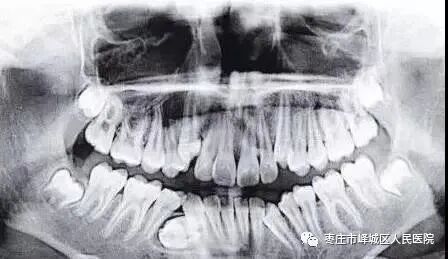 口腔ct怎么看您知道吗？口腔也可以做“CT”哦~_https://www.jmylbn.com_新闻资讯_第9张