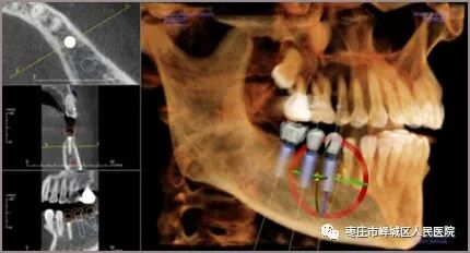 口腔ct怎么看您知道吗？口腔也可以做“CT”哦~_https://www.jmylbn.com_新闻资讯_第11张
