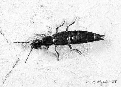 你当初拍死的不仅仅是只虫子 也是你的皮肤 痛 隐翅虫皮炎 惠八方华医世界 微信公众号文章阅读 Wemp