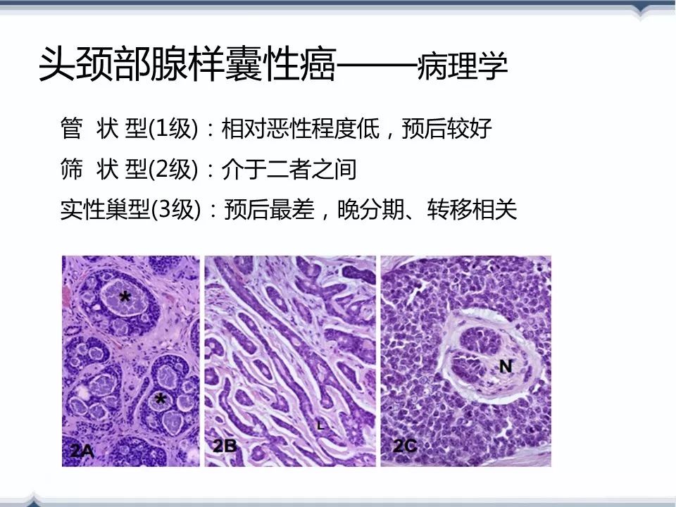 颌下腺腺样囊性癌神经侵犯的规律总结