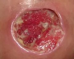 抗菌清创敷料有什么用基础知识：清创在伤口愈合中的重要作用_https://www.jmylbn.com_新闻资讯_第3张