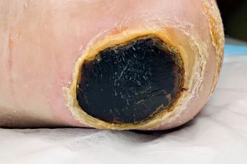 抗菌清创敷料有什么用基础知识：清创在伤口愈合中的重要作用_https://www.jmylbn.com_新闻资讯_第6张