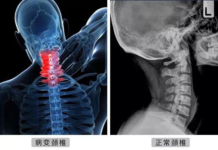 每天玩手機4小時，8年後開刀換骨：頸椎，正在成為中國人的死穴 科技 第6張
