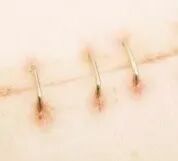 为什么要用皮钉缝合科普电台｜你听过钉皮机吗？_https://www.jmylbn.com_新闻资讯_第3张