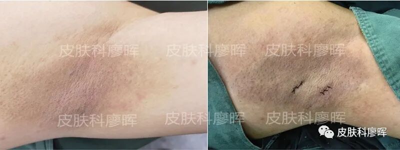 孩子多大可以做腋臭手术