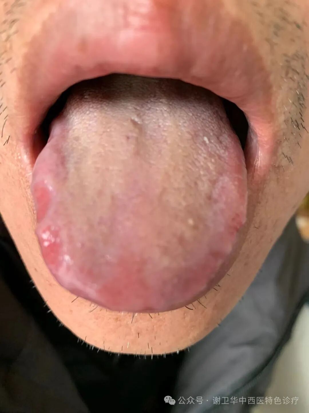 小柴胡与麻杏石甘汤合方的神奇效果