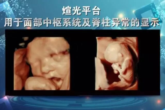 美国彩超怎么购买彩超界的网红—— 美国GE-E10四维彩超，你了解多少_https://www.jmylbn.com_新闻资讯_第6张