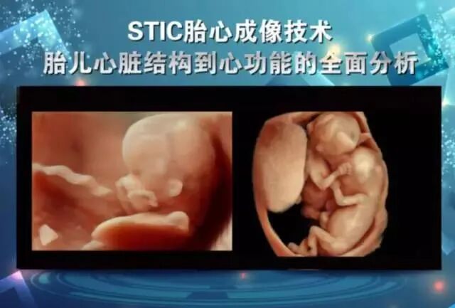 美国彩超怎么购买彩超界的网红—— 美国GE-E10四维彩超，你了解多少_https://www.jmylbn.com_新闻资讯_第9张