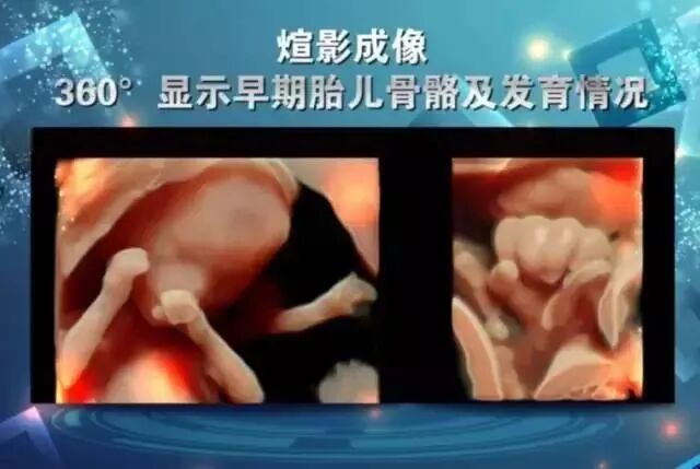 美国彩超怎么购买彩超界的网红—— 美国GE-E10四维彩超，你了解多少_https://www.jmylbn.com_新闻资讯_第7张