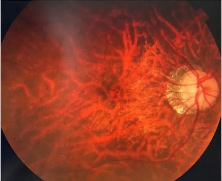 眼底照相能检查出什么眼底咔嚓拍张照 健康问题早知道_https://www.jmylbn.com_新闻资讯_第14张