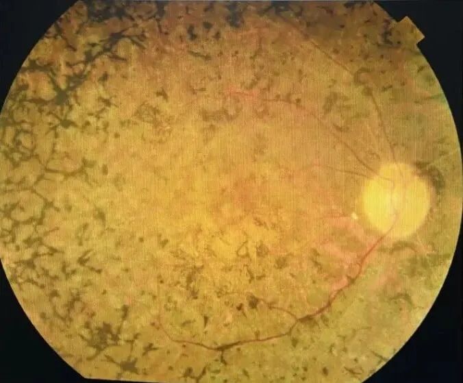 眼底照相能检查出什么眼底咔嚓拍张照 健康问题早知道_https://www.jmylbn.com_新闻资讯_第15张