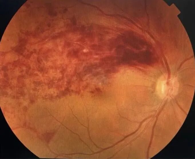 眼底照相能检查出什么眼底咔嚓拍张照 健康问题早知道_https://www.jmylbn.com_新闻资讯_第11张