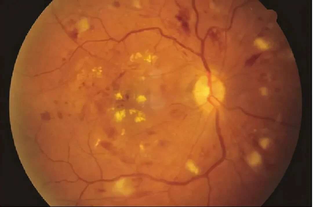 眼底照相能检查出什么眼底咔嚓拍张照 健康问题早知道_https://www.jmylbn.com_新闻资讯_第12张