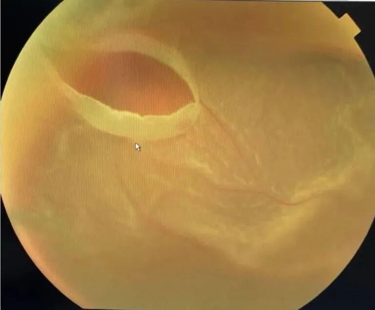 眼底照相能检查出什么眼底咔嚓拍张照 健康问题早知道_https://www.jmylbn.com_新闻资讯_第13张