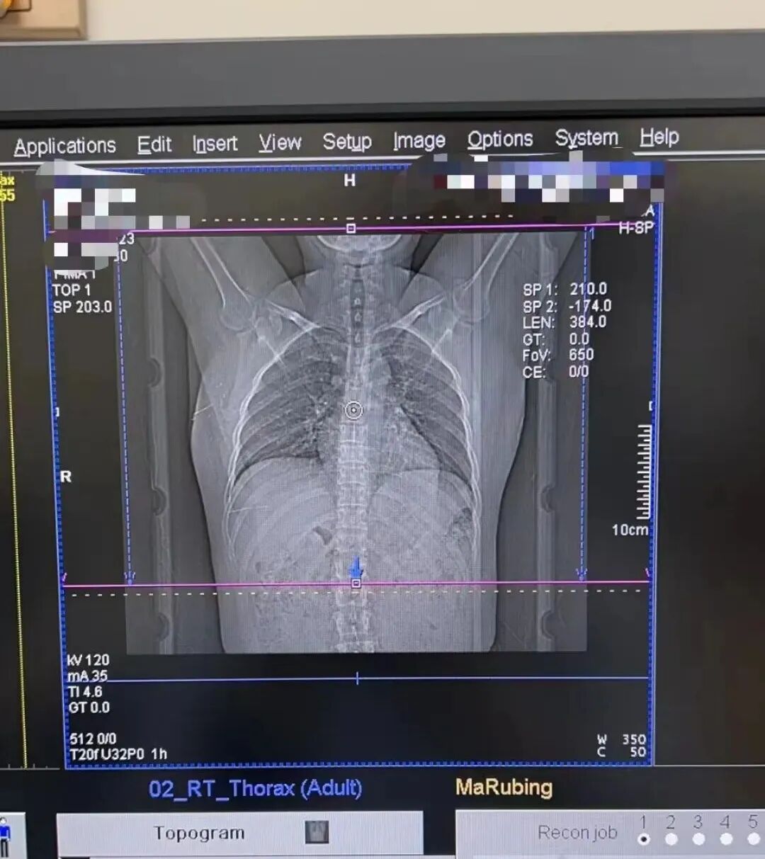 放疗怎么定位放疗知多少 ｜ 乳腺放疗第一步：定位！_https://www.jmylbn.com_新闻资讯_第6张