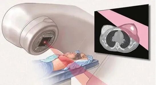 放疗怎么定位放疗知多少 ｜ 乳腺放疗第一步：定位！_https://www.jmylbn.com_新闻资讯_第2张