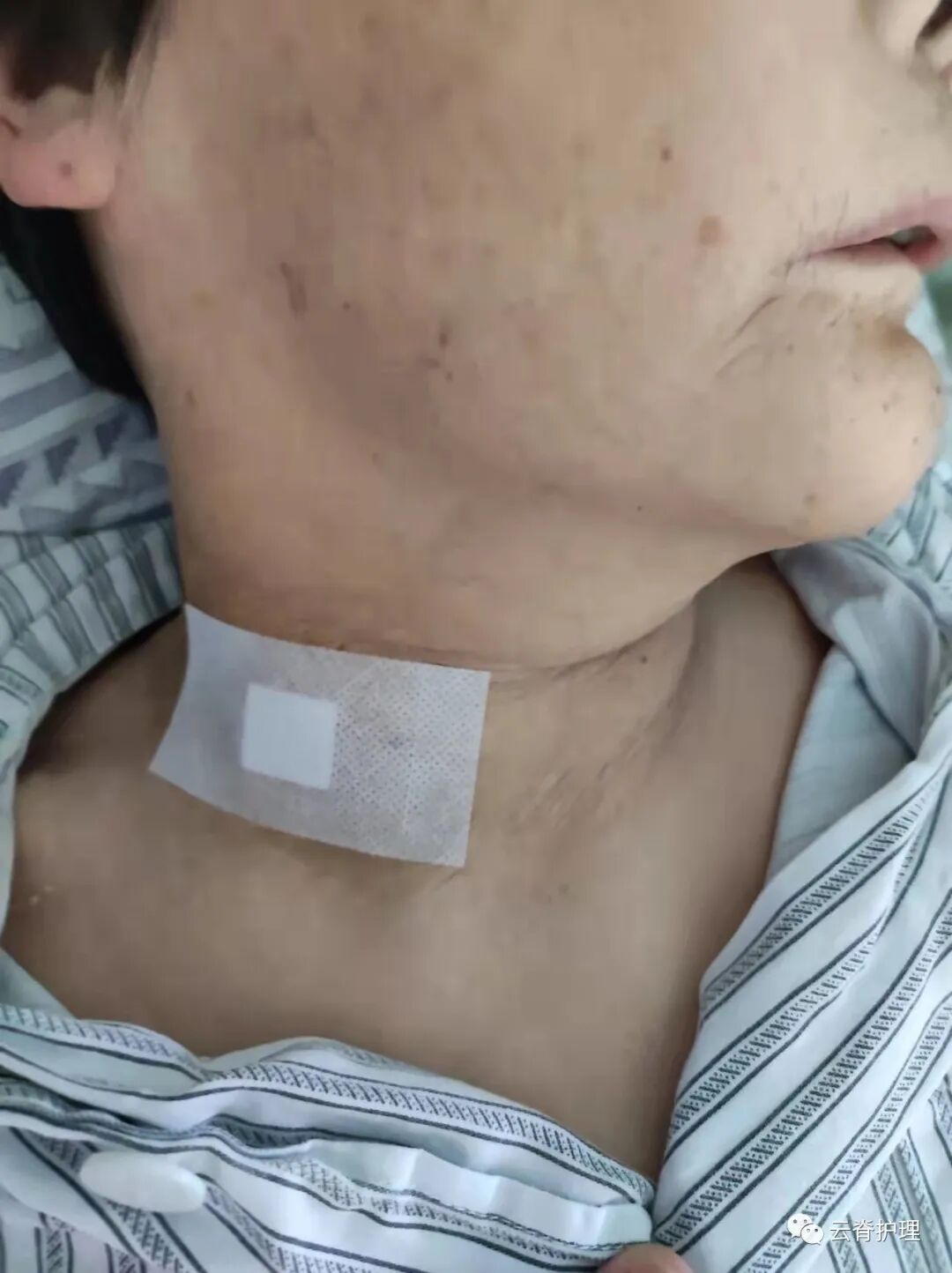 中心静脉导管是什么您颈部的针是什么？--中心静脉导管（CVC）_https://www.jmylbn.com_新闻资讯_第12张