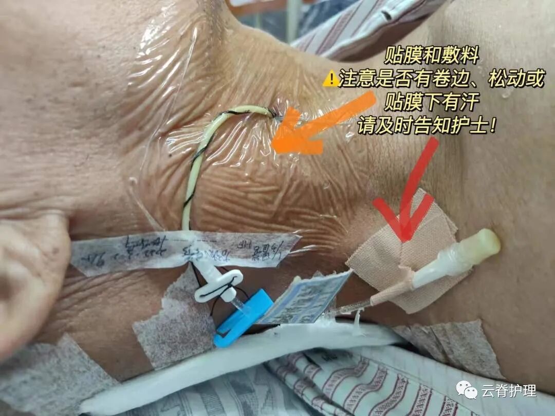 中心静脉导管是什么您颈部的针是什么？--中心静脉导管（CVC）_https://www.jmylbn.com_新闻资讯_第5张