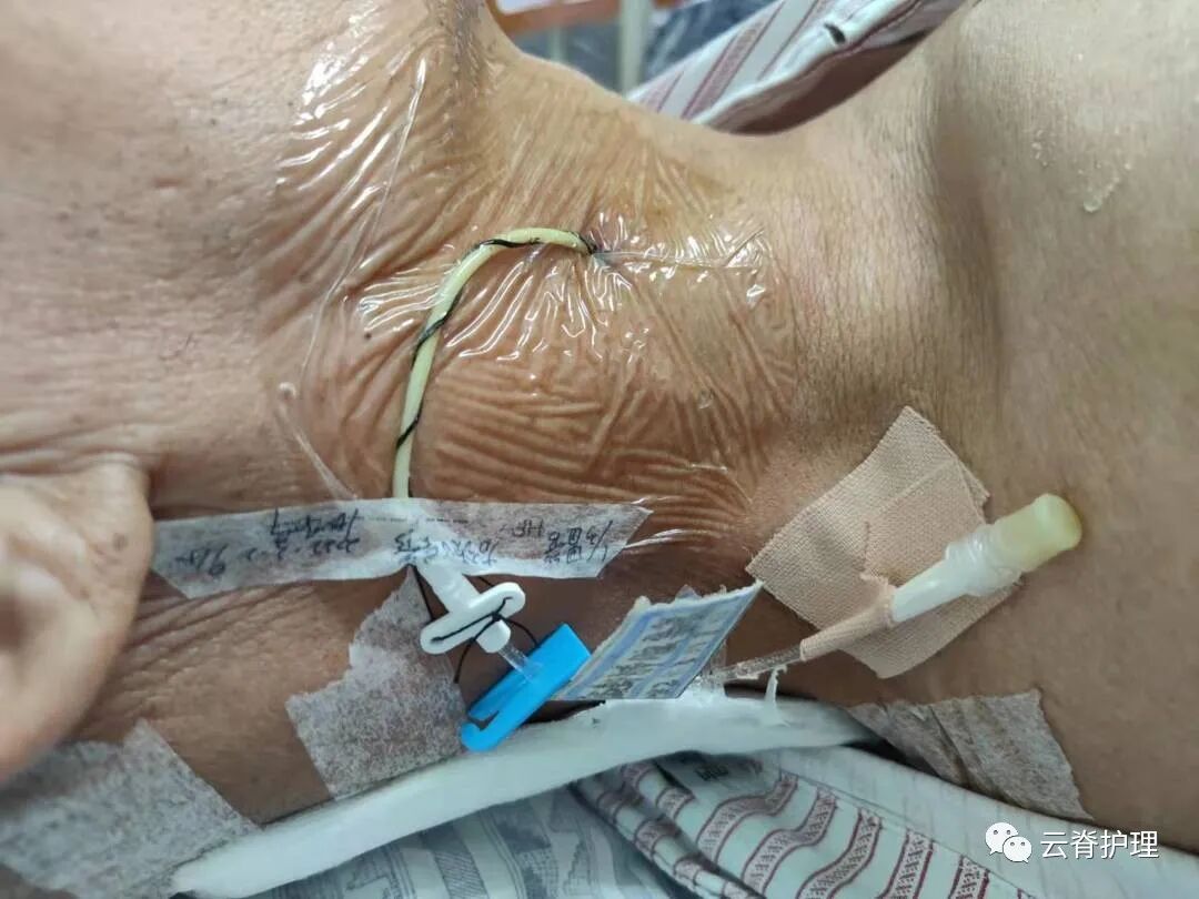 中心静脉导管是什么您颈部的针是什么？--中心静脉导管（CVC）_https://www.jmylbn.com_新闻资讯_第2张