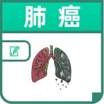 肺癌多是“拖”出来的，早期肺癌多有6种表现，别不当回事！