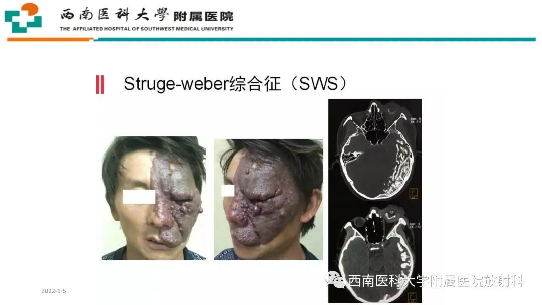 脑性偏身萎缩综合征（dyke-davidoff-masson syndrome）