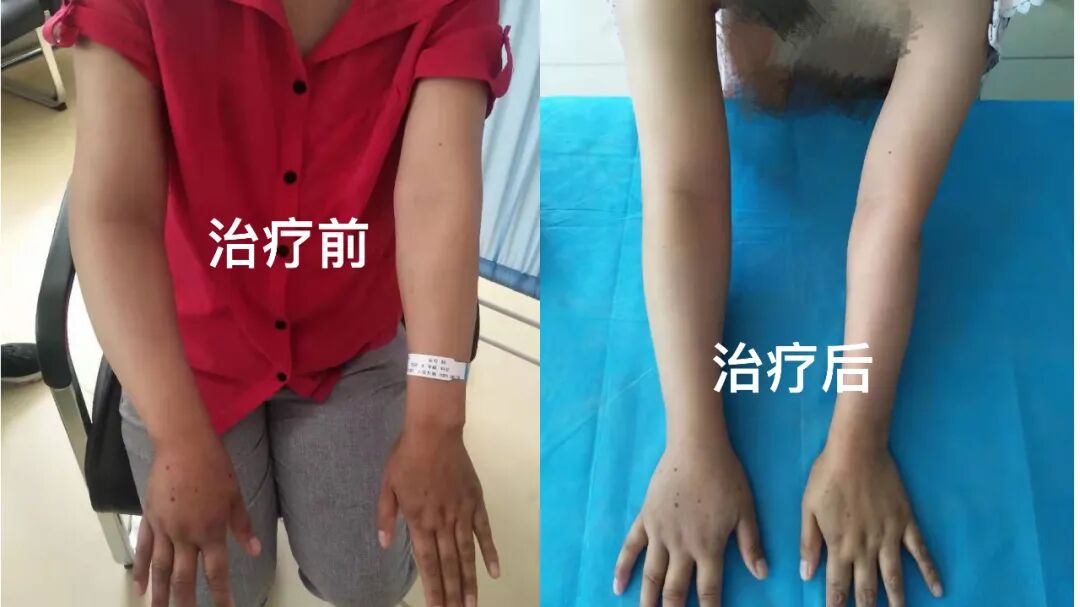 JC是什么手术乳腺癌手术后胳膊越来越肿，原因竟是……-上海聚慕医疗器械有限公司