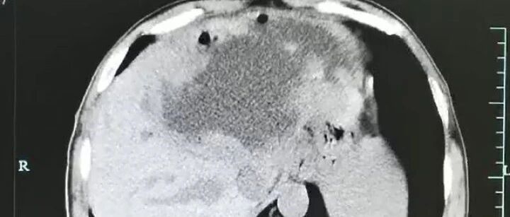 男子腹痛发烧!一查左肝竟被"吃空",壁上布满密密麻麻的虫卵,只因吃了…