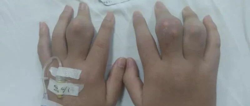 警惕!18岁"奶茶控"手脚关节长满"钻石",脚肿得无法走路!这个病正在年轻化