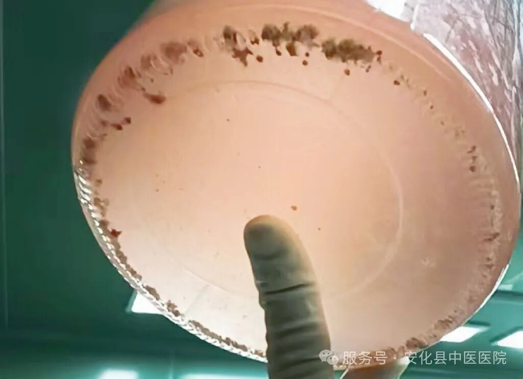 输尿管鞘是什么【技术突破】无创取石新利器——安化县中医医院成功开展可弯曲负压吸引鞘联合输尿管软镜钬激光碎石取石术•“卓越服务”系列报道（十六）_https://www.jmylbn.com_新闻资讯_第6张