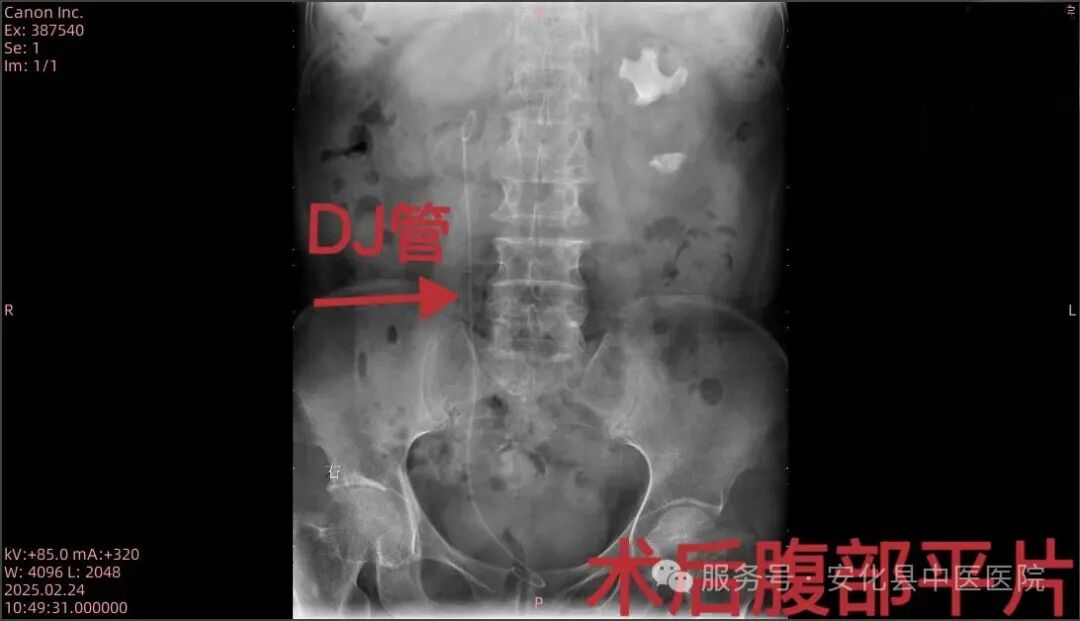 输尿管鞘是什么【技术突破】无创取石新利器——安化县中医医院成功开展可弯曲负压吸引鞘联合输尿管软镜钬激光碎石取石术•“卓越服务”系列报道（十六）_https://www.jmylbn.com_新闻资讯_第4张