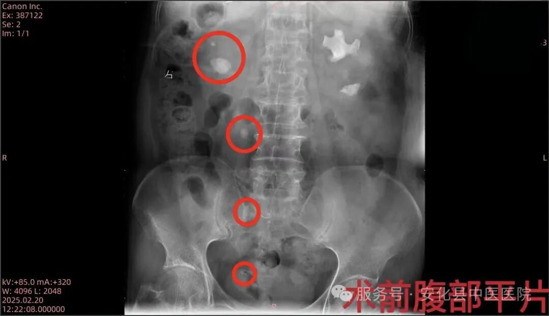 输尿管鞘是什么【技术突破】无创取石新利器——安化县中医医院成功开展可弯曲负压吸引鞘联合输尿管软镜钬激光碎石取石术•“卓越服务”系列报道（十六）_https://www.jmylbn.com_新闻资讯_第3张