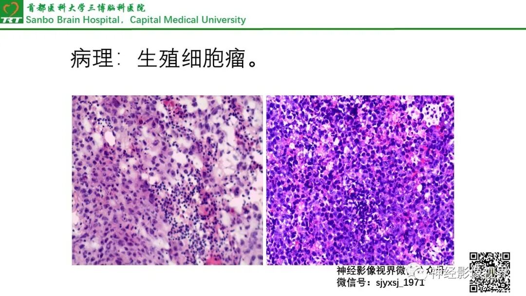 鞍区生殖细胞瘤影像与病例分享
