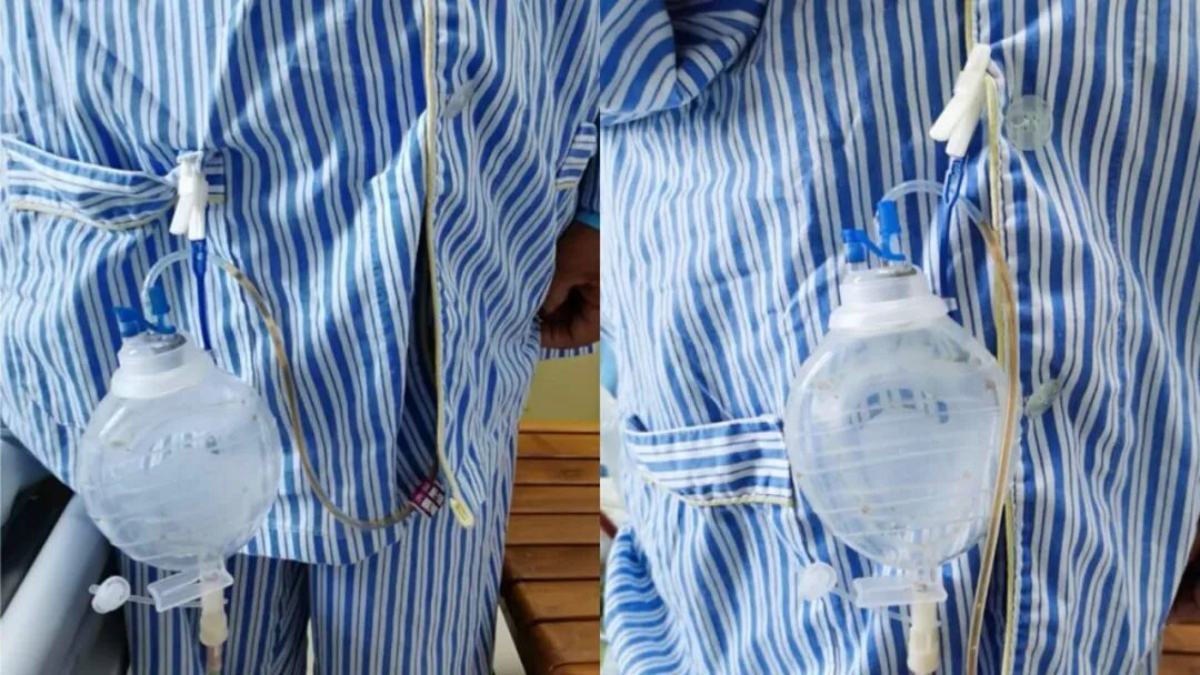 伤口引流袋怎么用保“管”学会——乳腺癌术后带管居家护理_https://www.jmylbn.com_新闻资讯_第19张