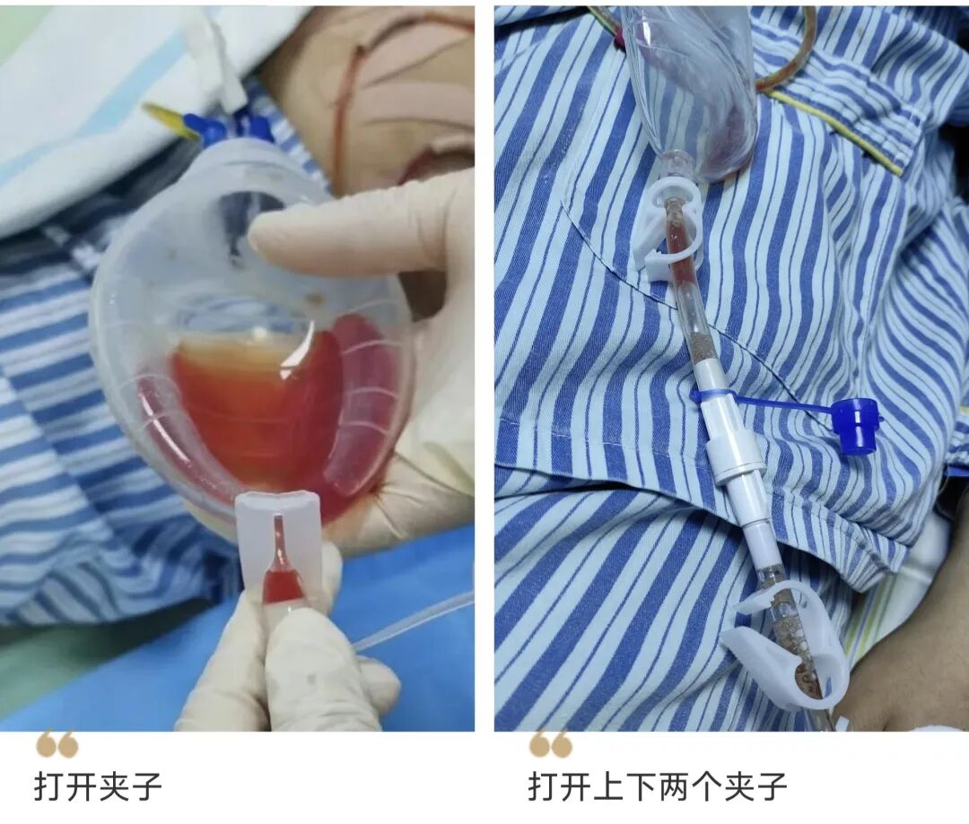 伤口引流袋怎么用保“管”学会——乳腺癌术后带管居家护理_https://www.jmylbn.com_新闻资讯_第11张