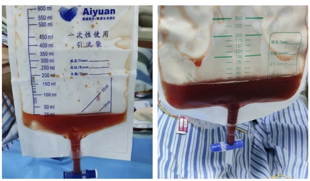 伤口引流袋怎么用保“管”学会——乳腺癌术后带管居家护理_https://www.jmylbn.com_新闻资讯_第15张